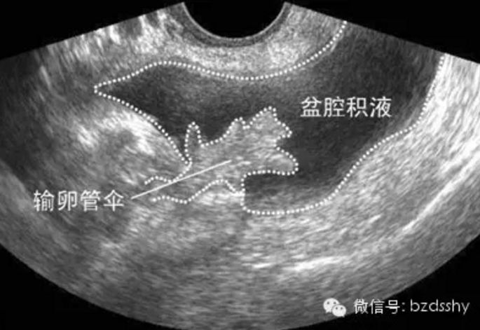 孕途国际什么是做供卵试管婴儿的合适年龄？